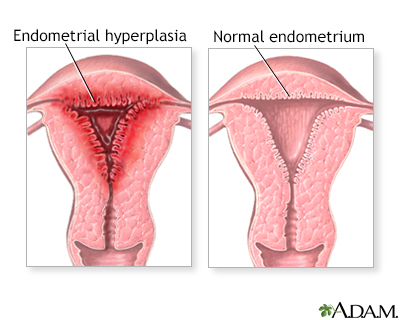 Endometriosis Information