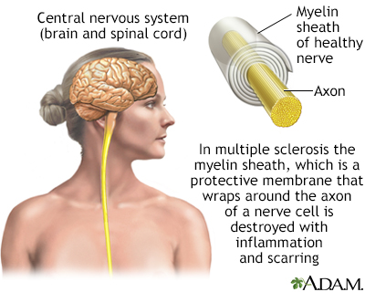 One-Sided MS Symptoms: The Experience and Its Explanation