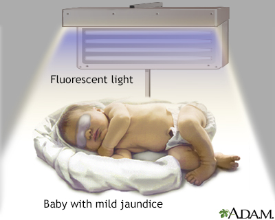 phototherapy for jaundice babies