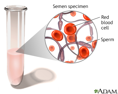 Blood in semen - Illustration Thumbnail
                      