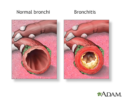 Bronchitis - Illustration Thumbnail