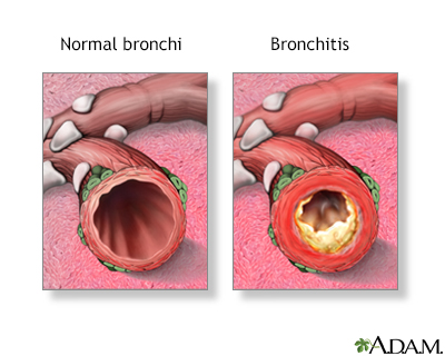 Bronchitis - Illustration Thumbnail              