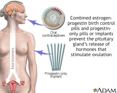 Hormone-based contraceptives - Illustration Thumbnail
                      