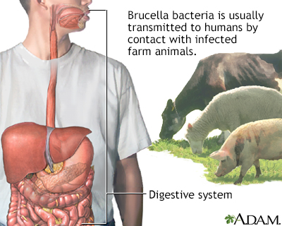 Brucellosis - Illustration Thumbnail
              