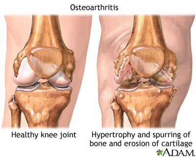 Osteoarthritis - Illustration Thumbnail              