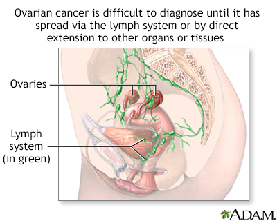 Ovarian cancer dangers - Illustration Thumbnail              
