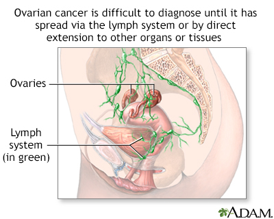 Ovarian cancer dangers - Illustration Thumbnail
              