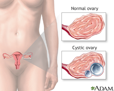 Ovarian cysts - Illustration Thumbnail
              