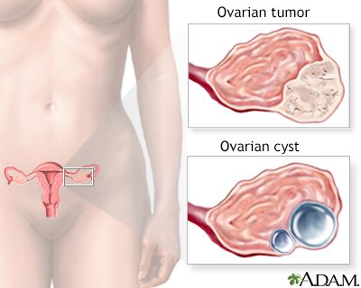 Ovarian cancer Information Mount Sinai New York