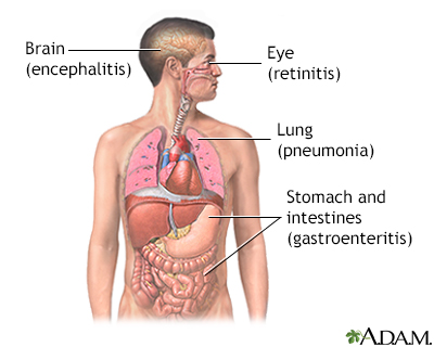 CMV (cytomegalovirus) - Illustration Thumbnail
              