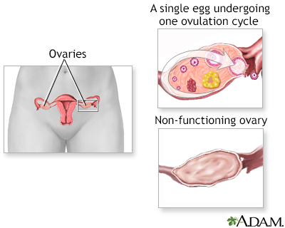 Ovarian hypofunction - Illustration Thumbnail
                      