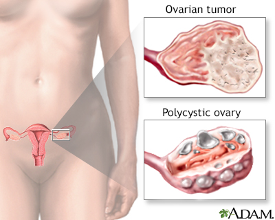 Overproductive ovaries - Illustration Thumbnail
              