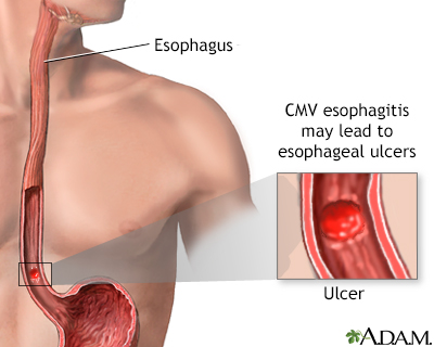 CMV esophagitis - Illustration Thumbnail
                      