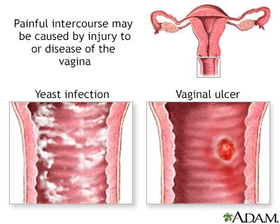 vaginitis painful atrophic intercourse vaginismus sexual causes vagina pain during tissue definition area treatment dyspareunia adam diseases physical occur symptoms