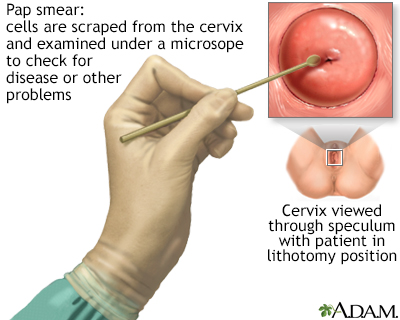 HIE Multimedia Cervical cancer