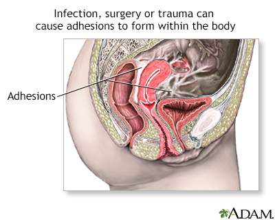 cancer abdominal adhesions