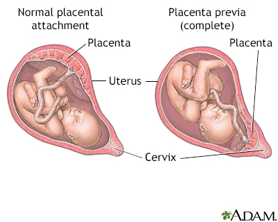 Vaginal bleeding in pregnancy Information Mount Sinai New York