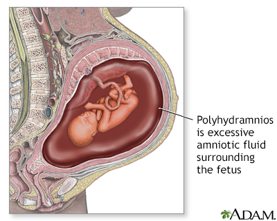 cephalic presentation with polyhydramnios