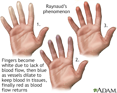 Raynaud's phenomenon - Illustration Thumbnail
              