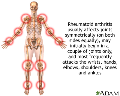 Rheumatoid arthritis - Illustration Thumbnail
                      