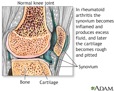 Rheumatoid arthritis - Illustration Thumbnail
                      