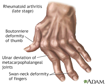 másodlagos rheumatoid arthritis)