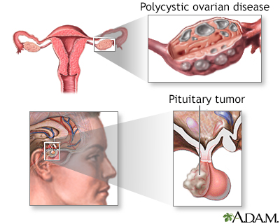 Secondary amenorrhea - Illustration Thumbnail
              