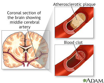 Thrombolytic therapy Information | Mount Sinai - New York