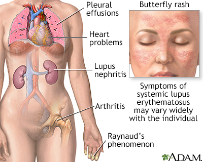 mild discoid rash