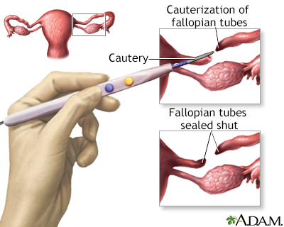 Tubal ligation - Illustration Thumbnail              