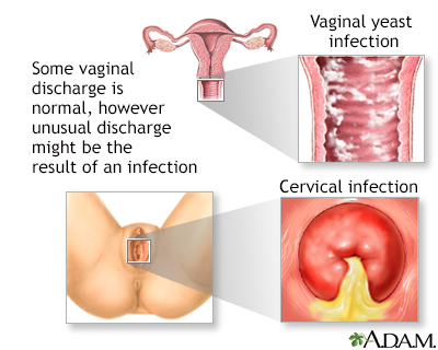 Vaginal Itching And Discharge Adult And Adolescent Information Mount Sinai New York