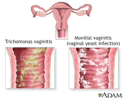 vaginal yeast infection discharge