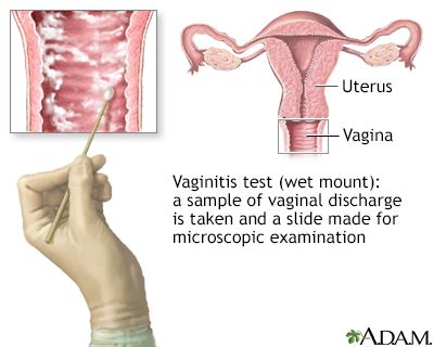 The wet mount vaginitis test - Illustration Thumbnail              