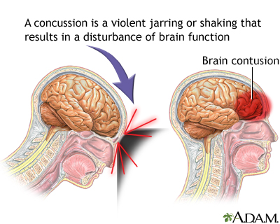 Concussion - Symptoms and Causes