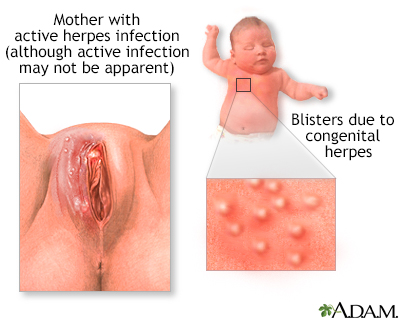 Congenital herpes - Illustration Thumbnail              