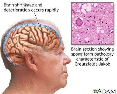 Creutzfeldt-Jakob disease - Illustration Thumbnail
                      