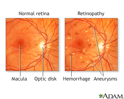 Diabetic retinopathy - Illustration Thumbnail							