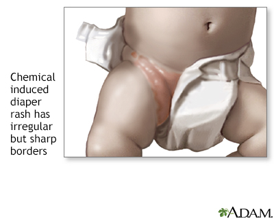 yeast vs regular diaper rash