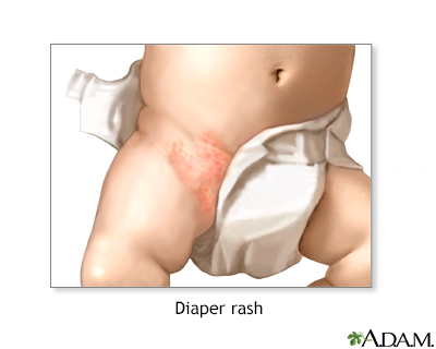 Diaper rash - Illustration Thumbnail
                      