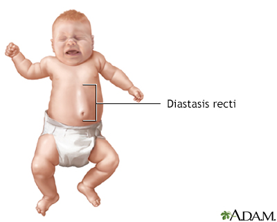 Diastasis recti - Illustration Thumbnail
              