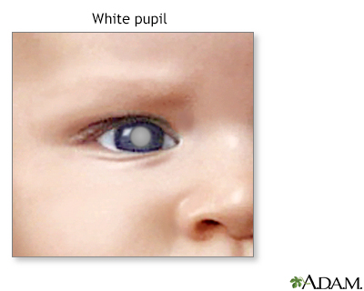 White spots in the pupil - Illustration Thumbnail
                      