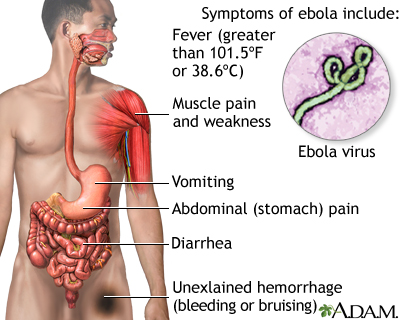 Ebola virus disease Information | Mount Sinai - New York
