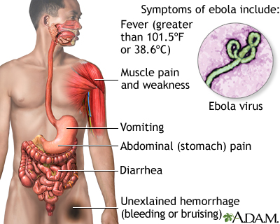 Ebola virus disease - Illustration Thumbnail
              