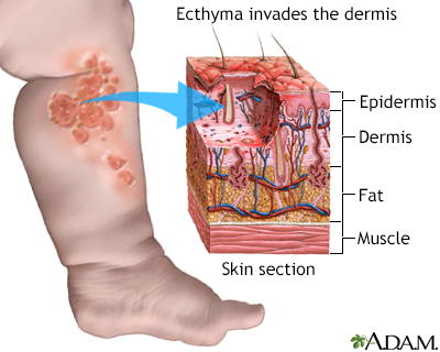 Ecthyma - Illustration Thumbnail
              