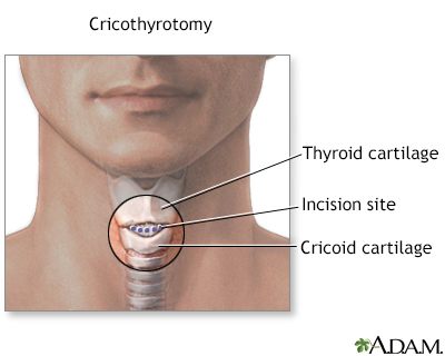 cricothyroid membrane incision