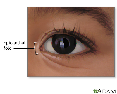 epicanthal folds vs normal