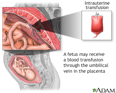 Intrauterine transfusion - Illustration Thumbnail
              