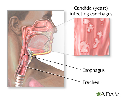 Candidal esophagitis - Illustration Thumbnail
              