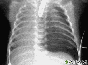 Pneumothorax - chest X-ray - Illustration Thumbnail              