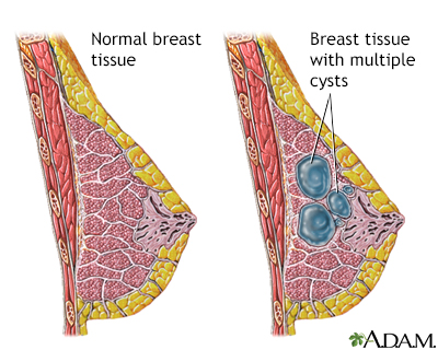 Fibrocystic breast disease Information Mount Sinai New York